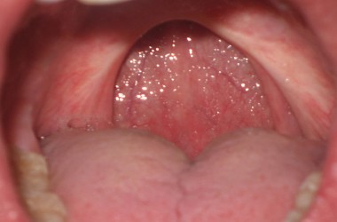 Uvulopalatopharyngoplasty - UPPP
